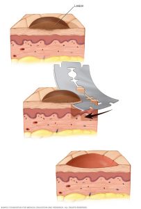 biopsia cutanta de tip shave ca metoda de diagnostic in bolile de piele