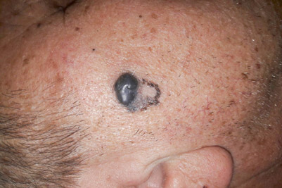 Imagine clinica melanom cutanat clinic obraz drept