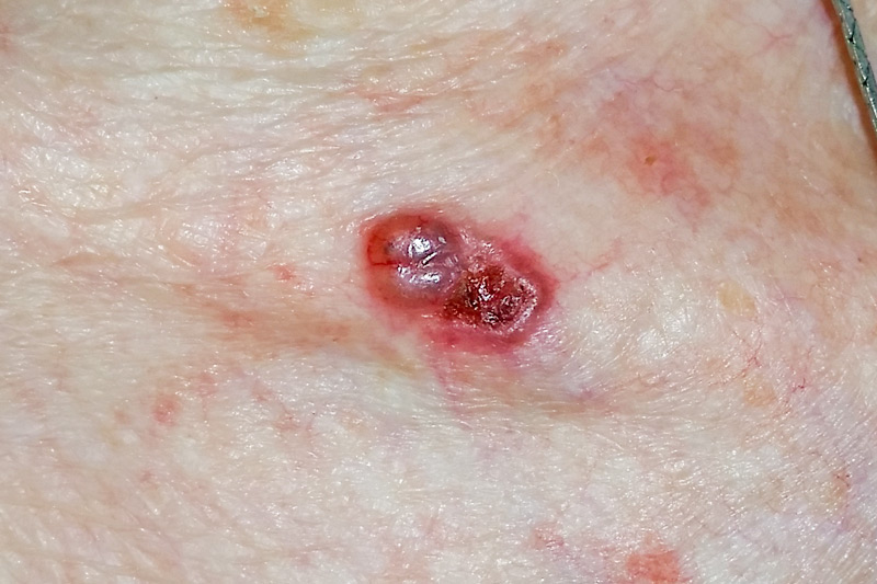 carcinom epiteliom bazocelular bazaliom piele tegument clavicula - cancer de piele malign - cancerele de piele