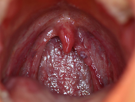 simptome ale verucilor genitale în gât