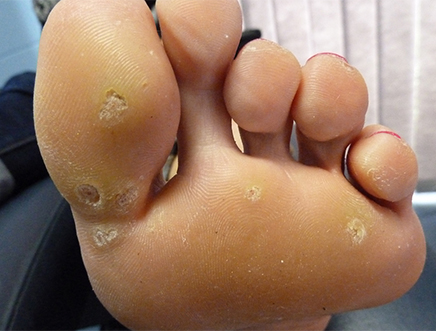 înlăturarea verucilor plantare clinice pielea dintre degetele de la picioare se uda