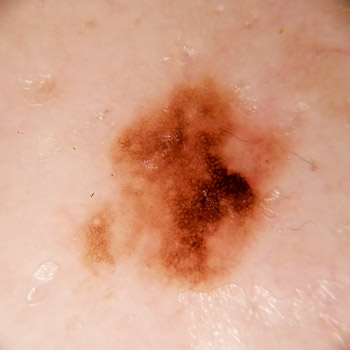 nev pigmentar atipic piele dermatoscopie alunita