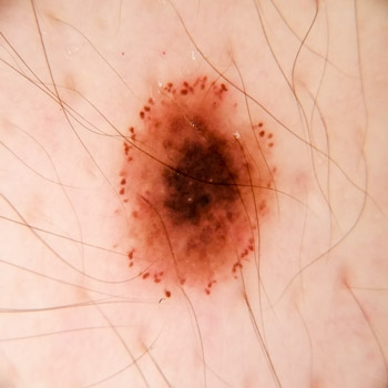 nev pigmentar in crestere alunita piele dermatoscopie