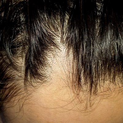 alopecia areata foto macro wide general