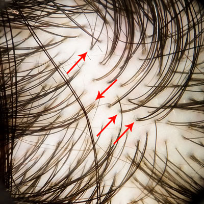 scalp normal imagine tricoscopie image hair scalp