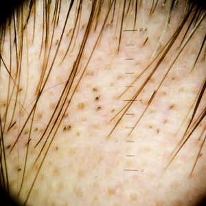 alopecia areata scalp par piele