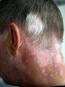vitiligo poliosis par alb barbat