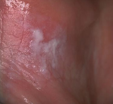 eroziune ulceratie lupus cavitate orala mucoase mucoasa bucala