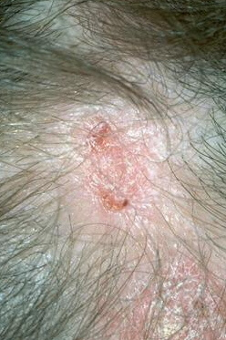 lupus discoid scalp alopecie cicatriciala permanenta cicatrice