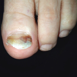 ciupercă dungi negre în unghii ce este ciuperca neglijată pe unghiile mâinilor tratament