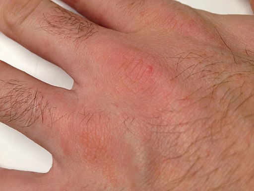 noduli de scabie pe pielea de pe mana