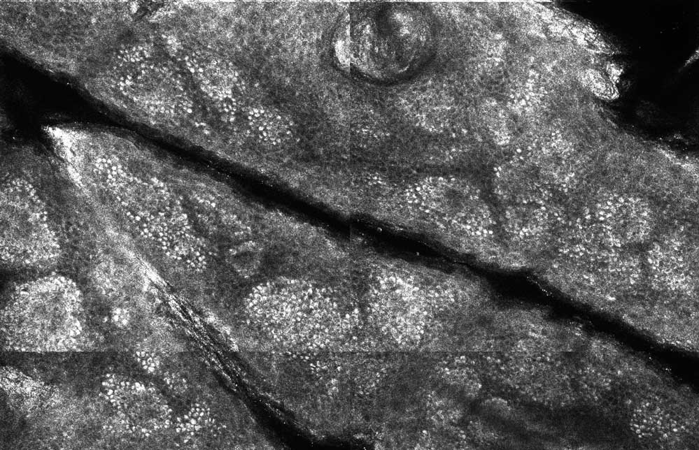 Stratul bazal la MCR - aspect de piatra de pavaj - biopsie optica, microscopie confocala