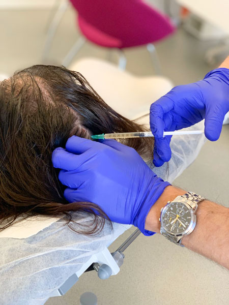 terapia prp - tehnica injectare scalp