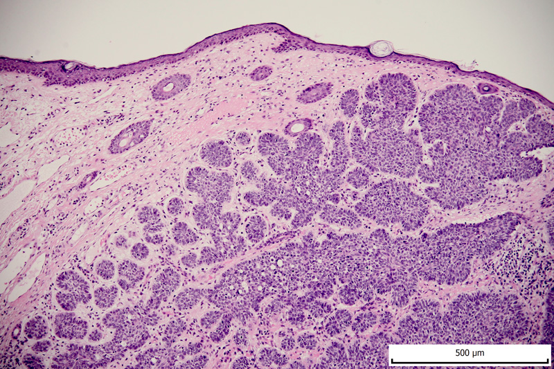 Carcinomul Bazocelular Cel Mai Frecvent Cancer De Piele Dr Mihai Lupu