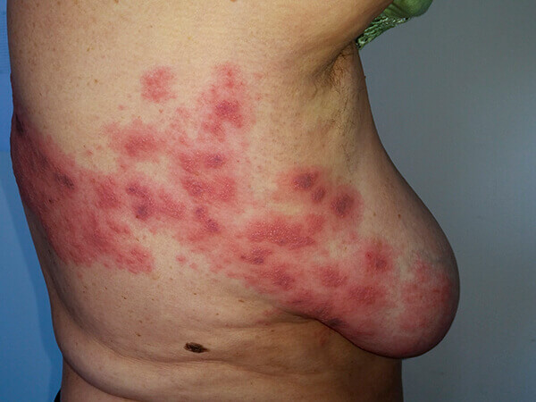 Herpes varicose