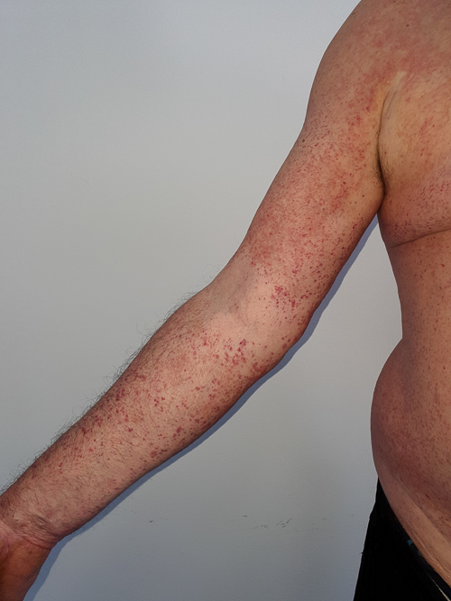 Dermatita alergica la intepatura de purice