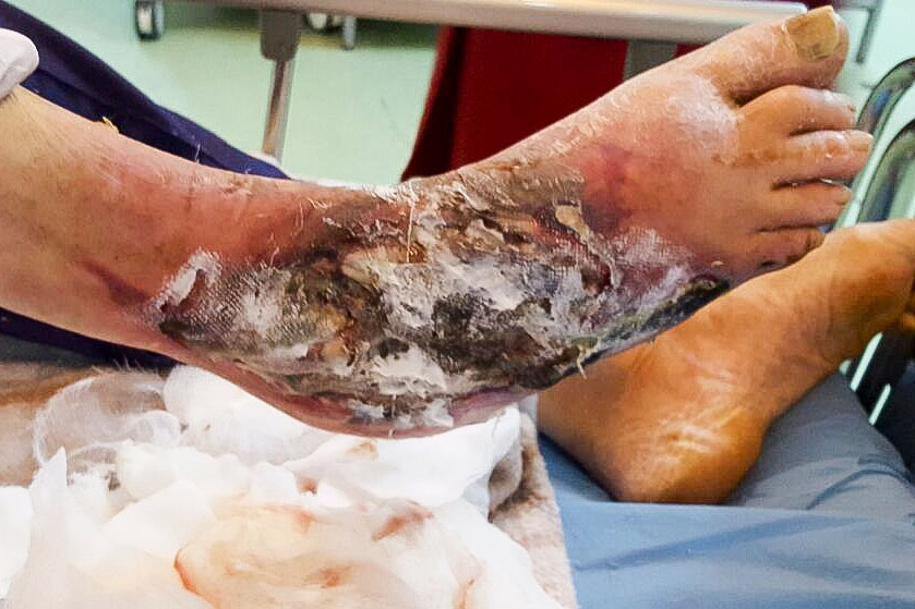 ulcer de gamba arterial