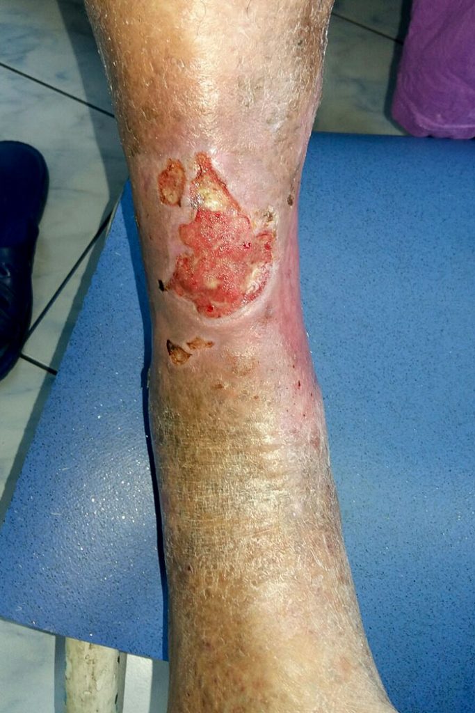 ulcer de gamba insuficienta venoasa cronica