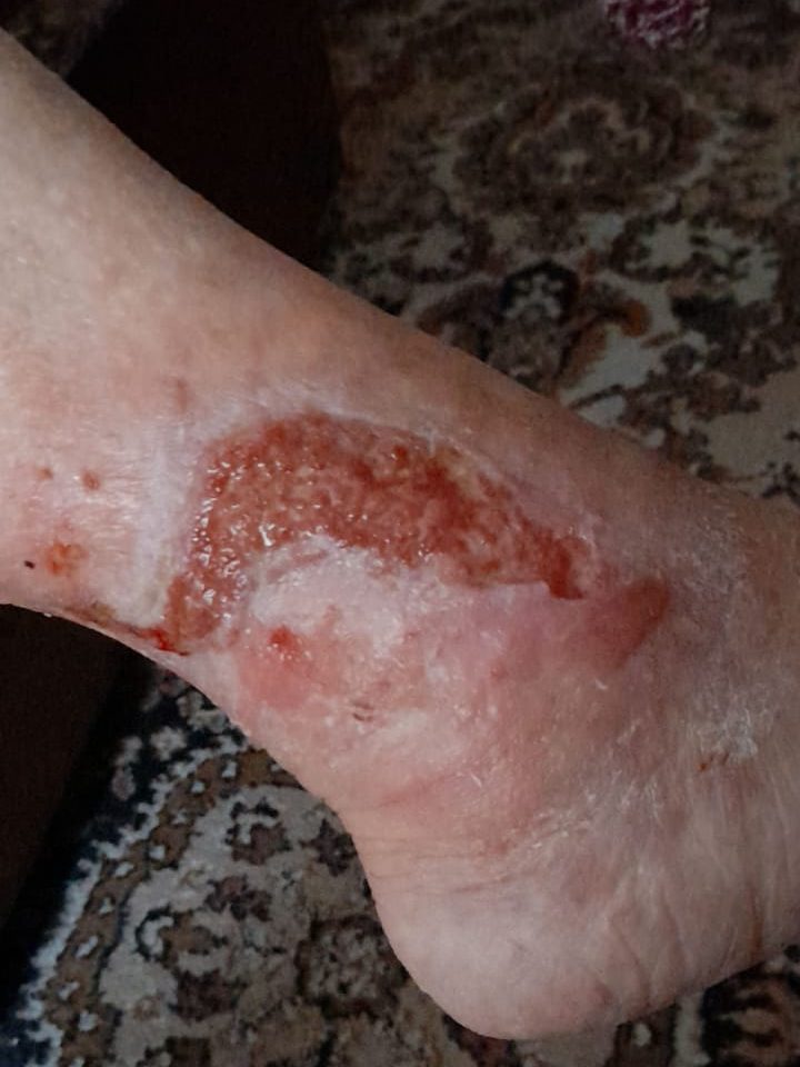 ulcer de gamba venos